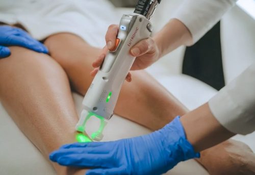 Laser hair removal with Clarity II