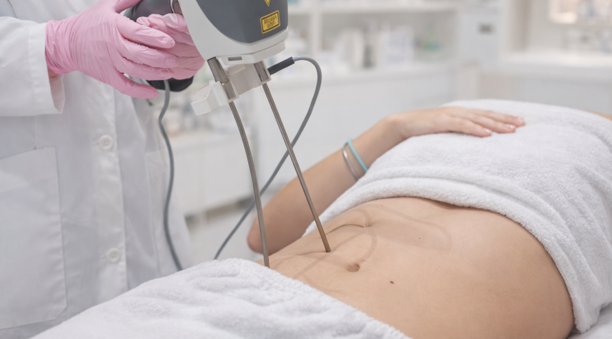 What is TightSculpting?